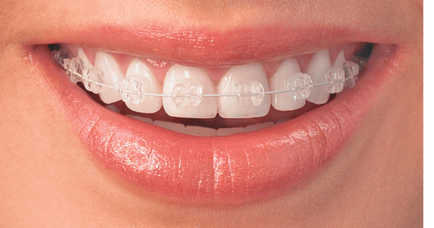 Ceramic braces in Lahore, Pakistan